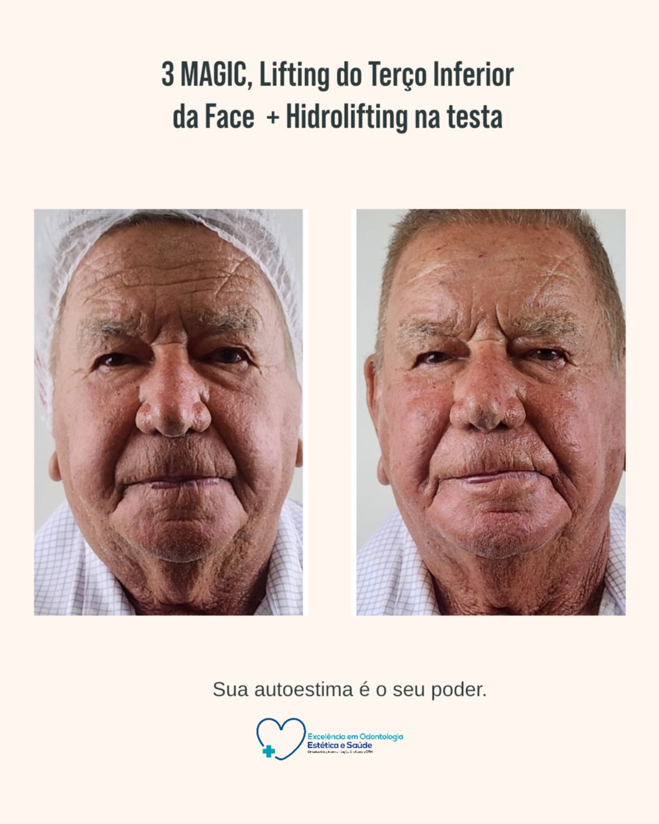 Harmonização Facial no Vila Imperial | Facecorp Estética Avançada