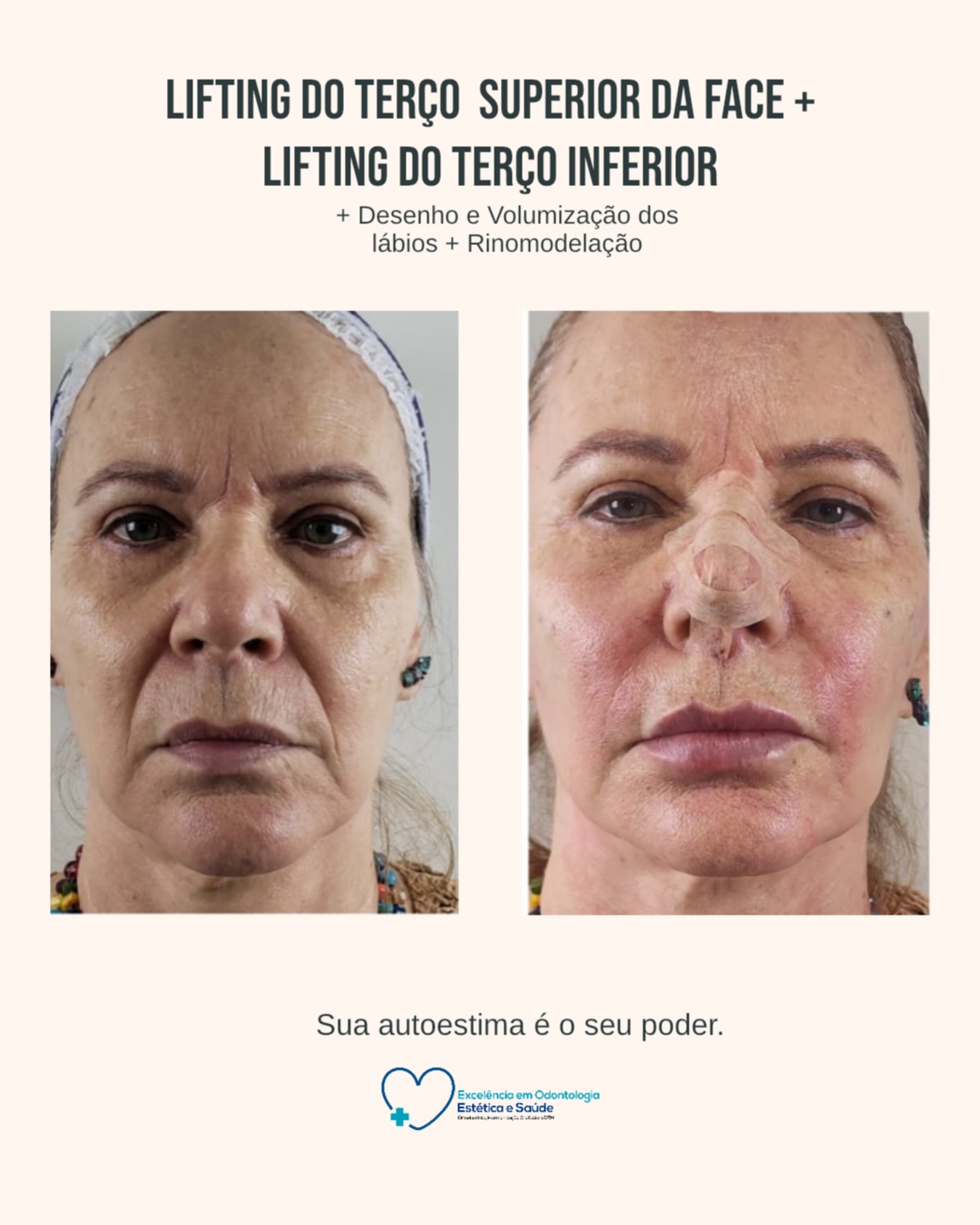 Lifting no Vila Imperial - SP | Facecorp Estética Avançada Lifting no Vila Imperial - SP | Facecorp Estética Avançada