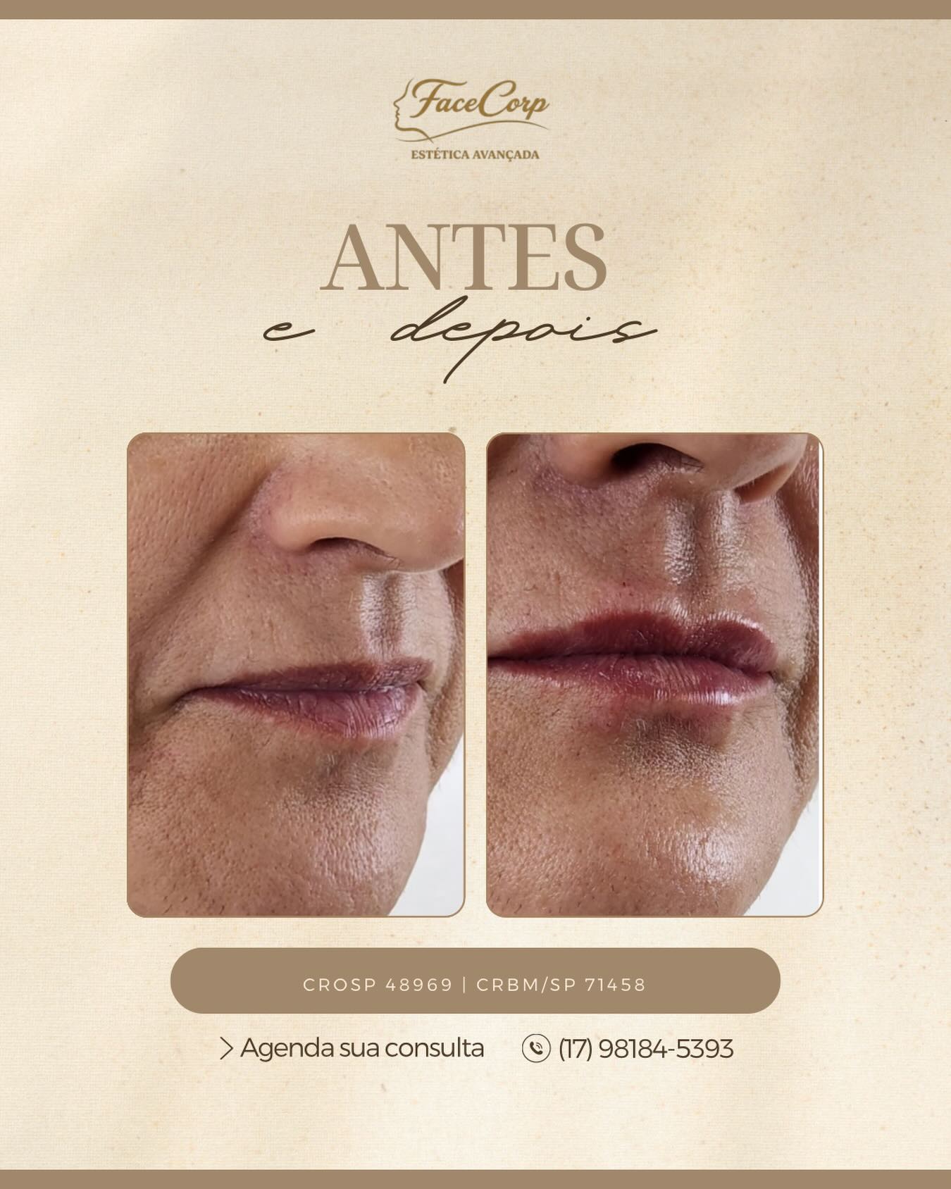 Preenchimento Labial no Vila Imperial | Facecorp Estética Avançada