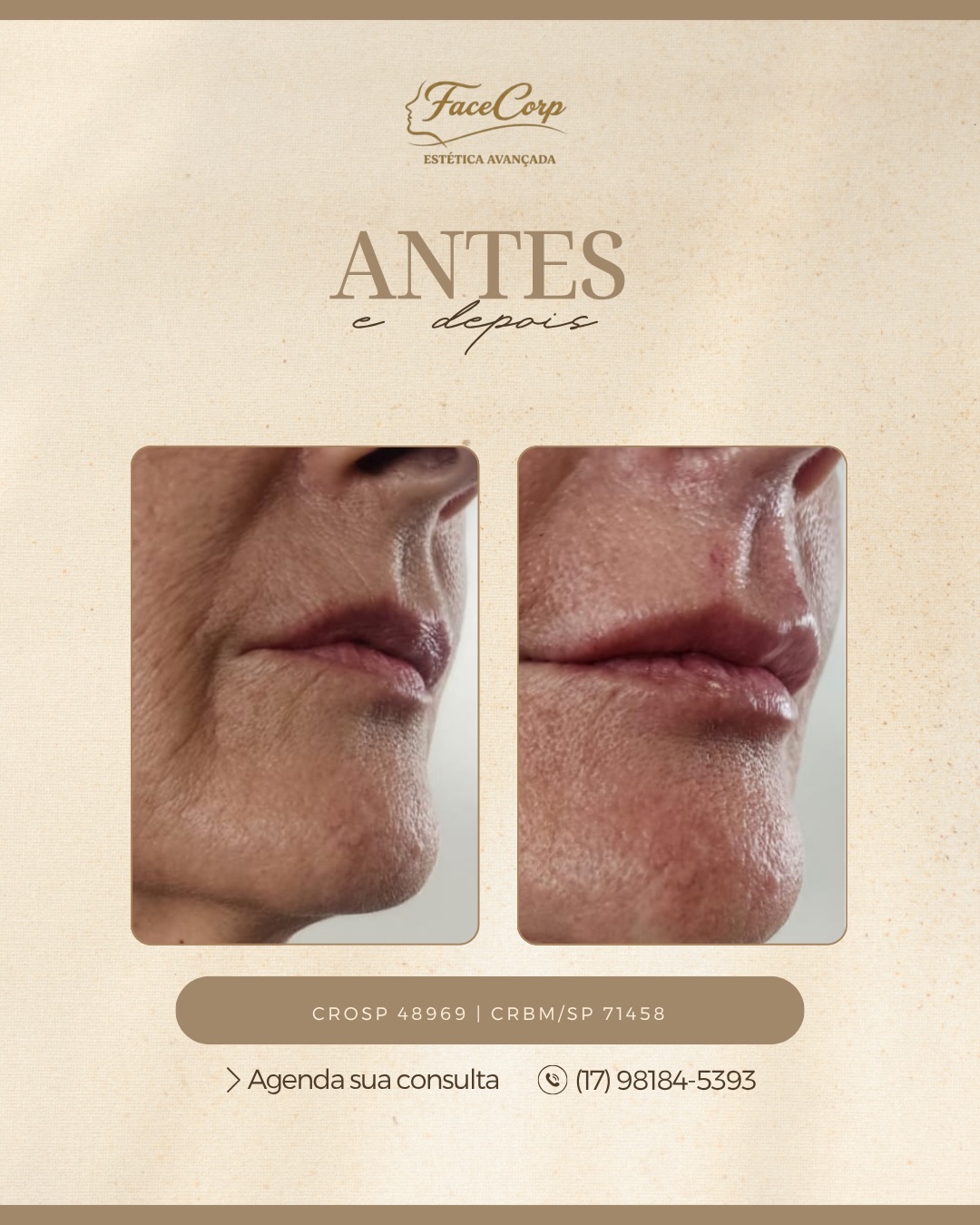Preenchimento Labial no Vila Imperial | Facecorp Estética Avançada