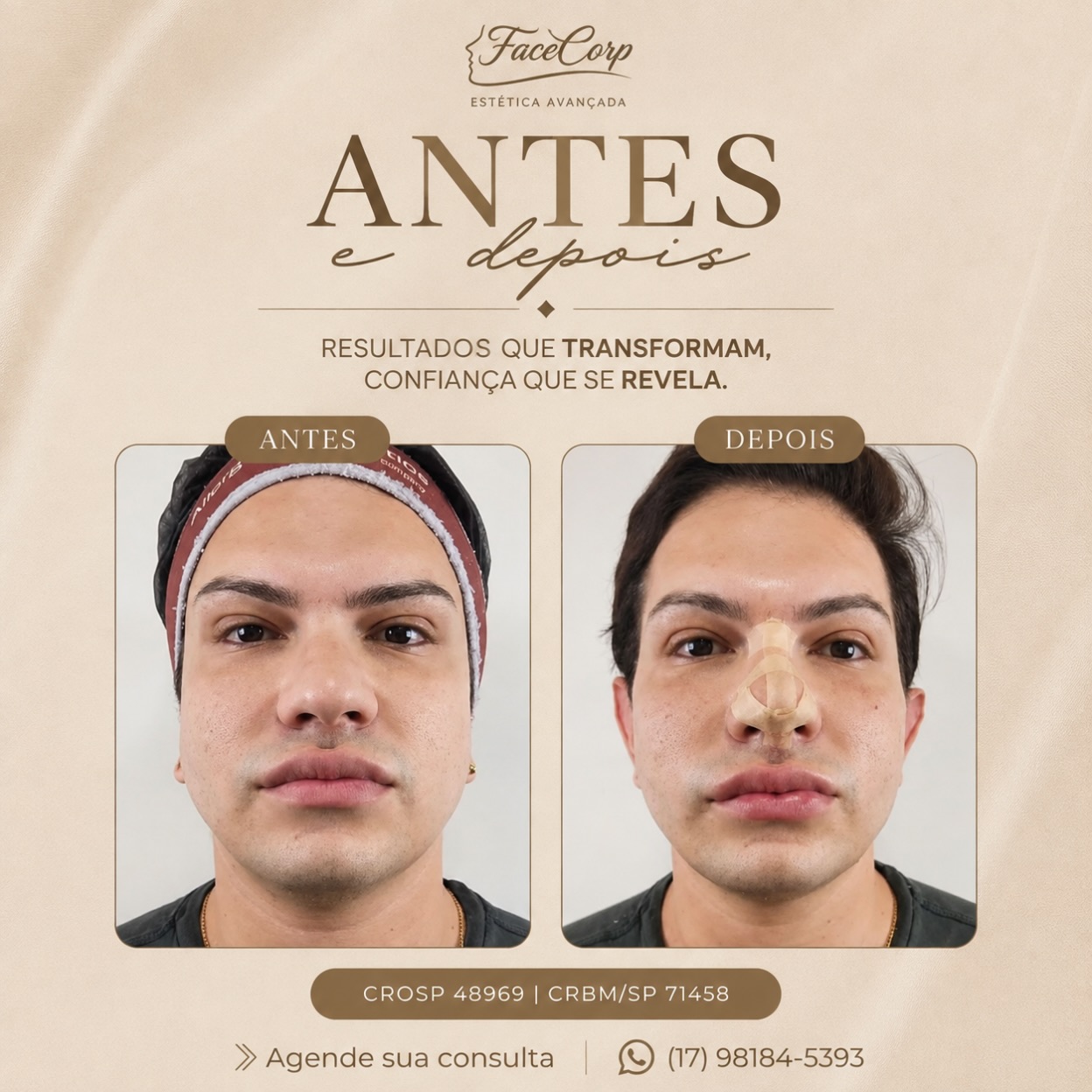 Rinomodelação em São José do Rio Preto - SP | Facecorp Estética