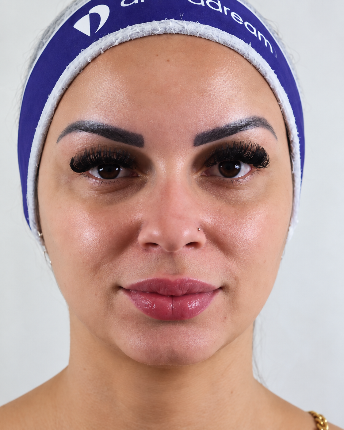 Rinomodelação em São José do Rio Preto - SP | Facecorp Estética