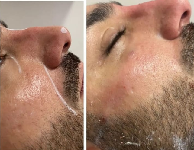 Antes e depois — Facecorp Estética Avançada, Saúde e Harmonização Oro Facial