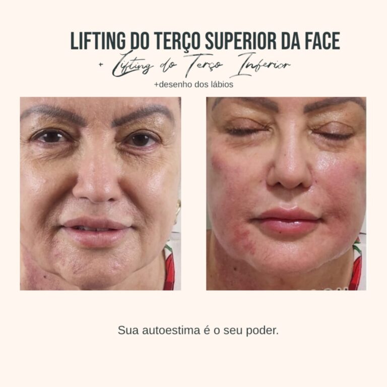 Antes e depois · Facecorp Estética Avançada, Saúde e Harmonização Oro Facial — Vila Imperial, São José do Rio Preto - SP