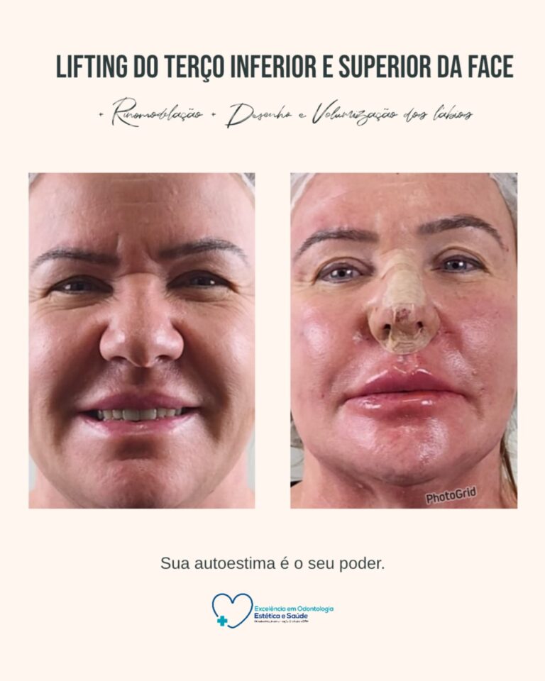 Antes e depois · Facecorp Estética Avançada, Saúde e Harmonização Oro Facial — Vila Imperial, São José do Rio Preto - SP