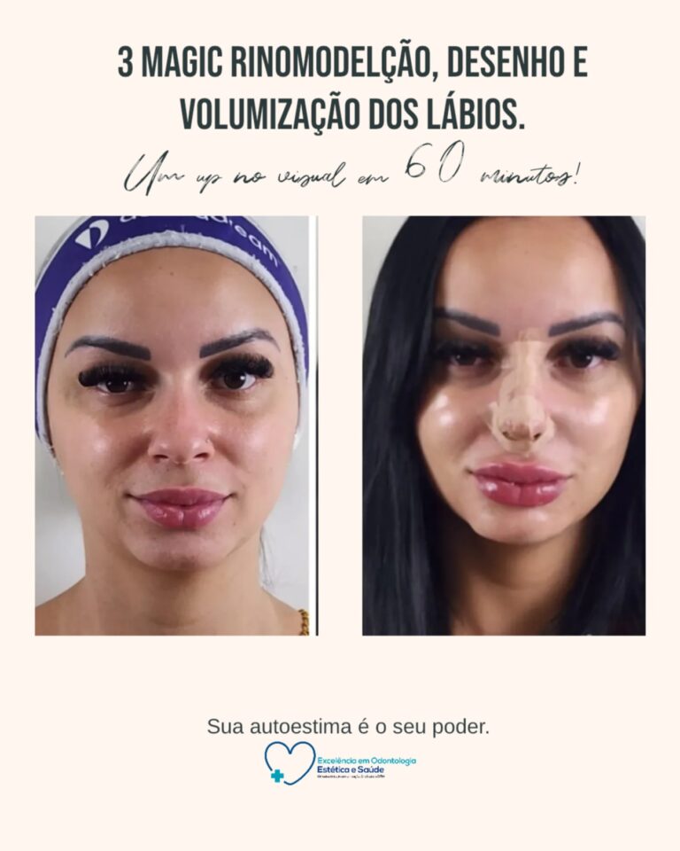 Antes e depois · Facecorp Estética Avançada, Saúde e Harmonização Oro Facial — Vila Imperial, São José do Rio Preto - SP