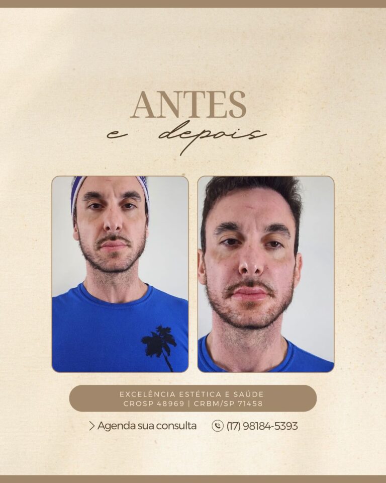 Antes e depois · Facecorp Estética Avançada, Saúde e Harmonização Oro Facial — Vila Imperial, São José do Rio Preto - SP