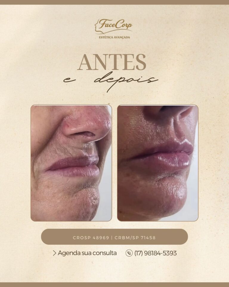 Antes e depois · Facecorp Estética Avançada, Saúde e Harmonização Oro Facial — Vila Imperial, São José do Rio Preto - SP