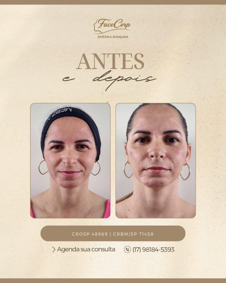 Antes e depois · Facecorp Estética Avançada, Saúde e Harmonização Oro Facial — Vila Imperial, São José do Rio Preto - SP