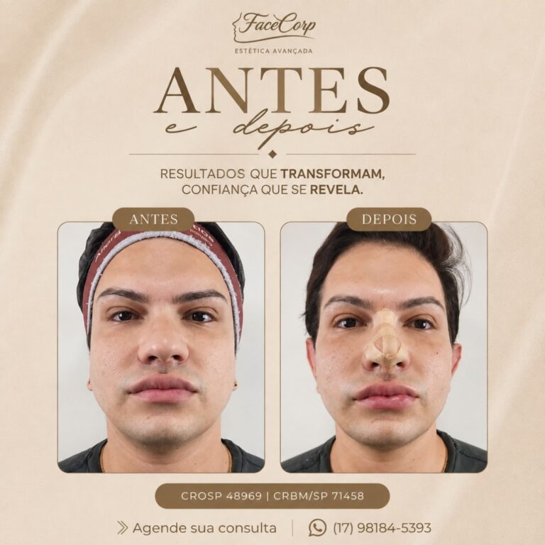 Antes e depois · Facecorp Estética Avançada, Saúde e Harmonização Oro Facial — Vila Imperial, São José do Rio Preto - SP