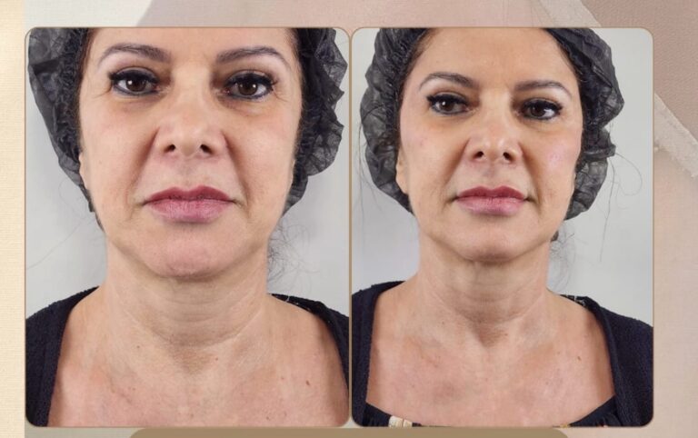Antes e depois · Facecorp Estética Avançada, Saúde e Harmonização Oro Facial — Vila Imperial, São José do Rio Preto - SP