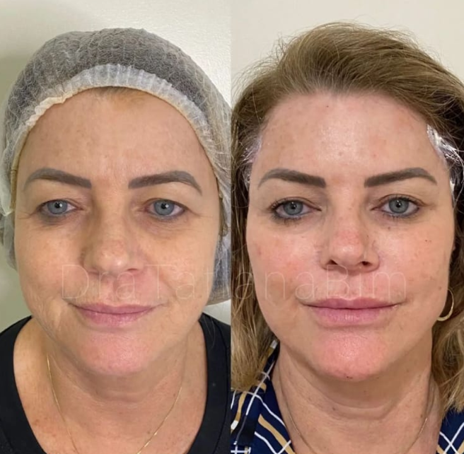 Antes e depois — Facecorp Estética Avançada, Saúde e Harmonização Oro Facial