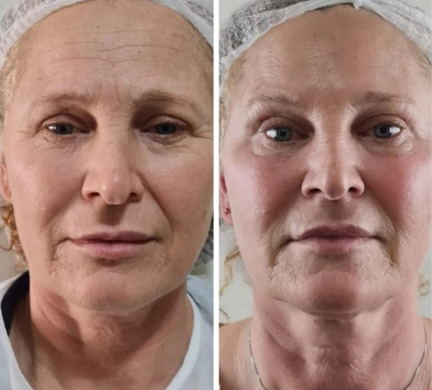 Antes e depois — Facecorp Estética Avançada, Saúde e Harmonização Oro Facial