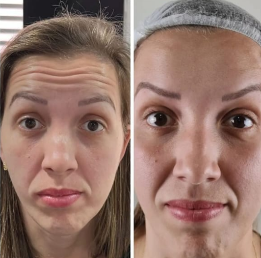 Antes e depois — Facecorp Estética Avançada, Saúde e Harmonização Oro Facial