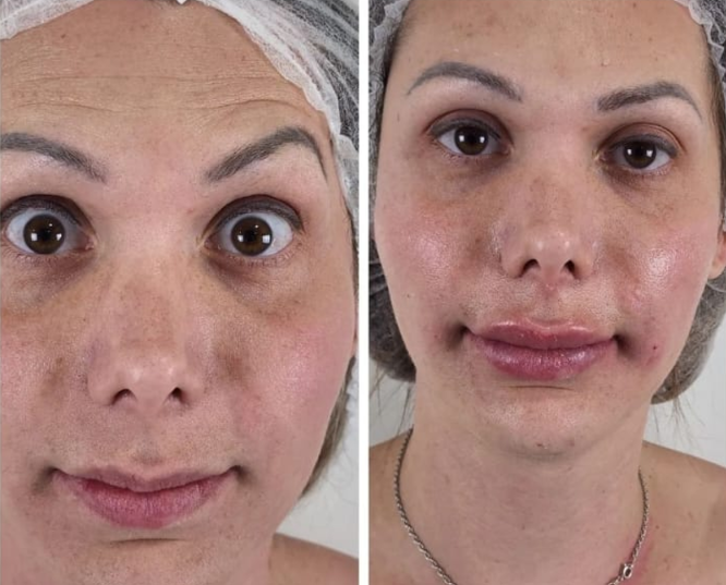 Antes e depois — Facecorp Estética Avançada, Saúde e Harmonização Oro Facial