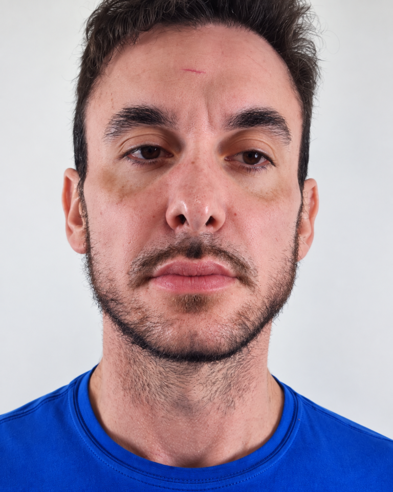 Harmonização Facial no Vila Imperial | Facecorp Estética Avançada