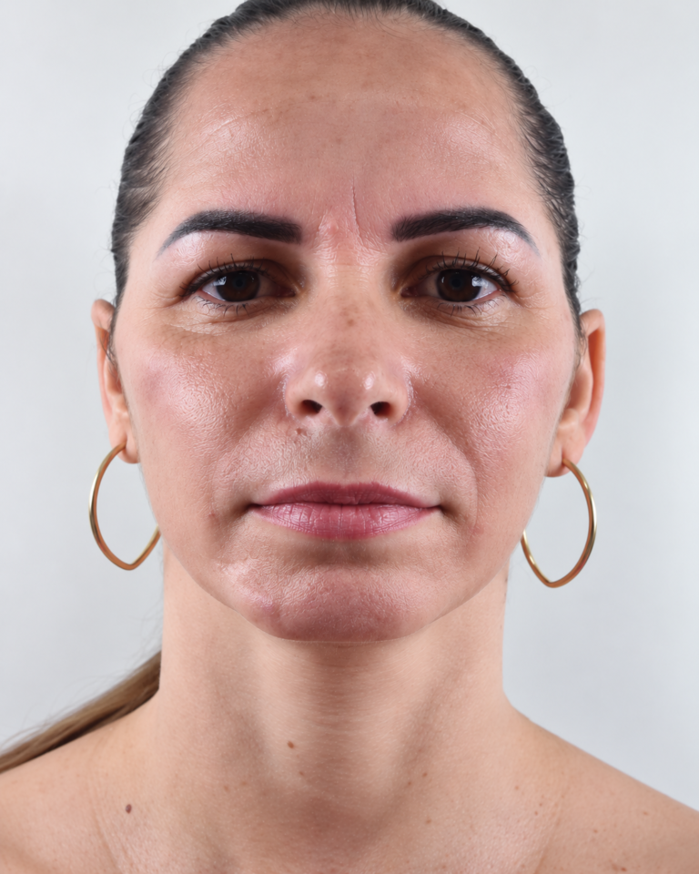 Preenchimento de Bigode Chinês em São José do Rio Preto – SP | Facecorp