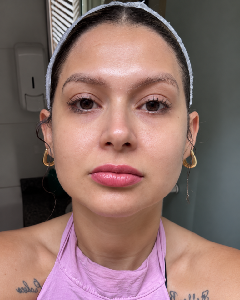 NEURALGIA de Trigêmeo no Vila Imperial | Facecorp Estética Avançada