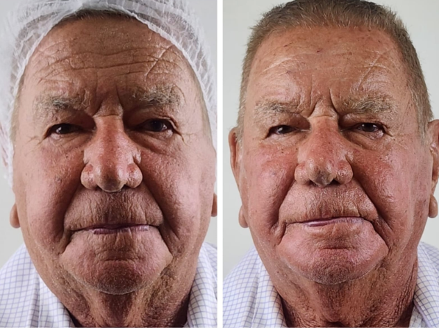 Antes e depois — Facecorp Estética Avançada, Saúde e Harmonização Oro Facial