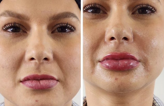 Antes e depois — Facecorp Estética Avançada, Saúde e Harmonização Oro Facial