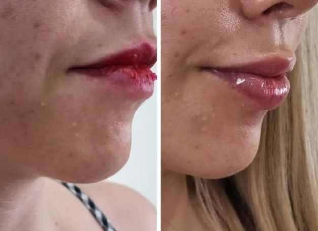Antes e depois — Facecorp Estética Avançada, Saúde e Harmonização Oro Facial