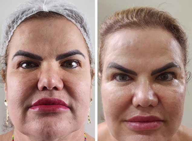 Antes e depois — Facecorp Estética Avançada, Saúde e Harmonização Oro Facial