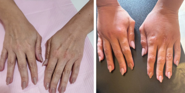 Antes e depois — Facecorp Estética Avançada, Saúde e Harmonização Oro Facial