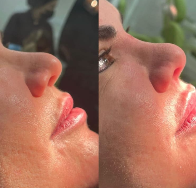 Antes e depois — Facecorp Estética Avançada, Saúde e Harmonização Oro Facial