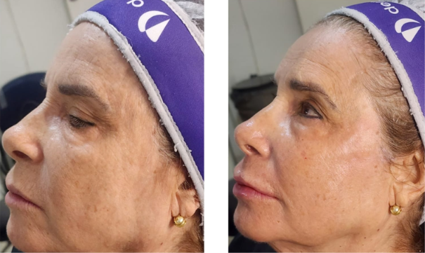 Antes e depois — Facecorp Estética Avançada, Saúde e Harmonização Oro Facial