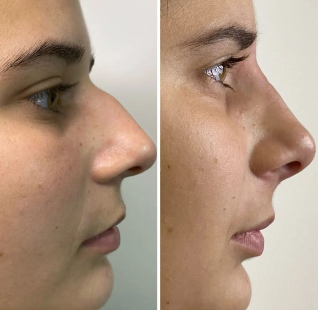 Antes e depois — Facecorp Estética Avançada, Saúde e Harmonização Oro Facial