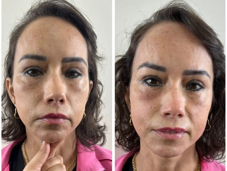 Antes e depois · Facecorp Estética Avançada, Saúde e Harmonização Oro Facial — Vila Imperial, São José do Rio Preto - SP