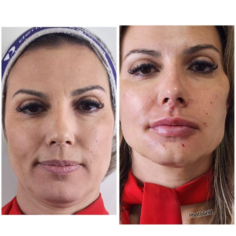 Rinomodelação · Facecorp Estética Avançada, Saúde e Harmonização Oro Facial — Vila Imperial, São José do Rio Preto - SP