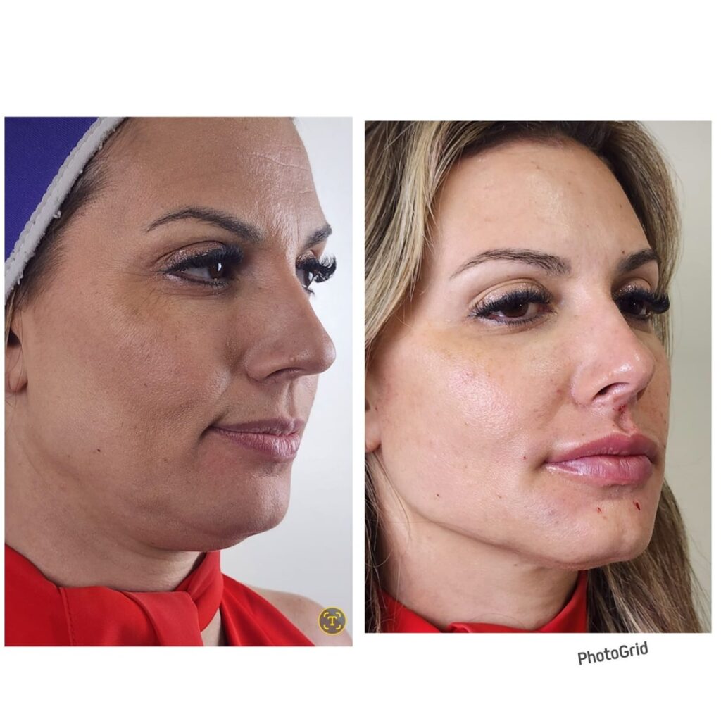 Rinomodelação – Facecorp Estética Avançada, Saúde e Harmonização Oro Facial, São José do Rio Preto - SP – foto 2