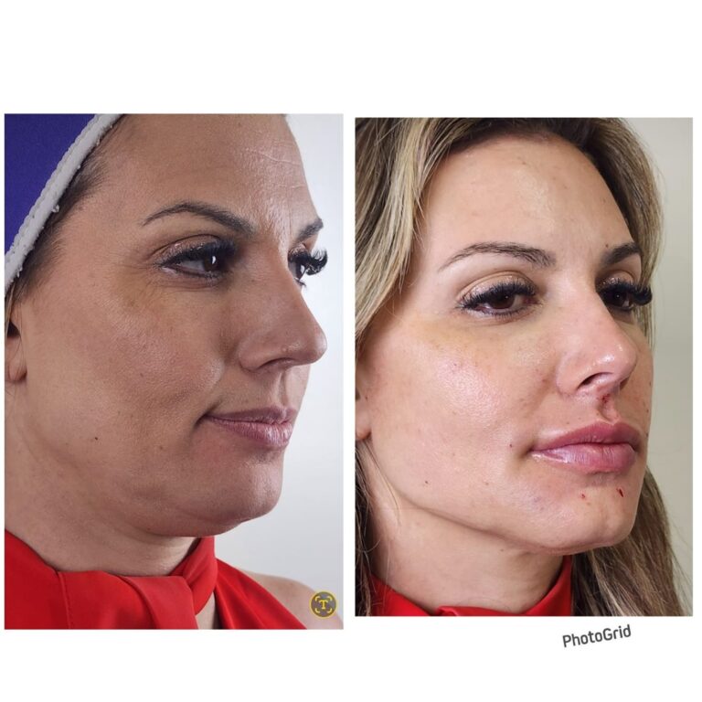 Rinomodelação · Facecorp Estética Avançada, Saúde e Harmonização Oro Facial — Vila Imperial, São José do Rio Preto - SP