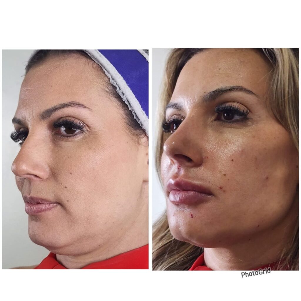 Rinomodelação – Facecorp Estética Avançada, Saúde e Harmonização Oro Facial, São José do Rio Preto - SP – foto 1